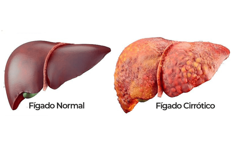 álcool, foto de um fígado saudável e um fígado com cirrose